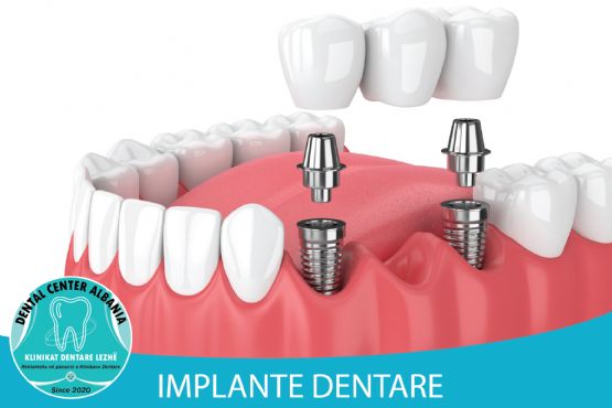 Mbjellje dhëmbi me implante dentare me ETK + Plus 3D